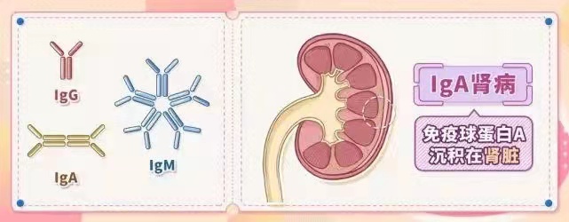 什么是IgA腎病
