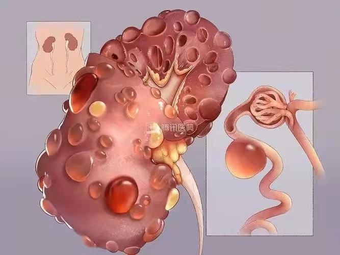 多囊腎