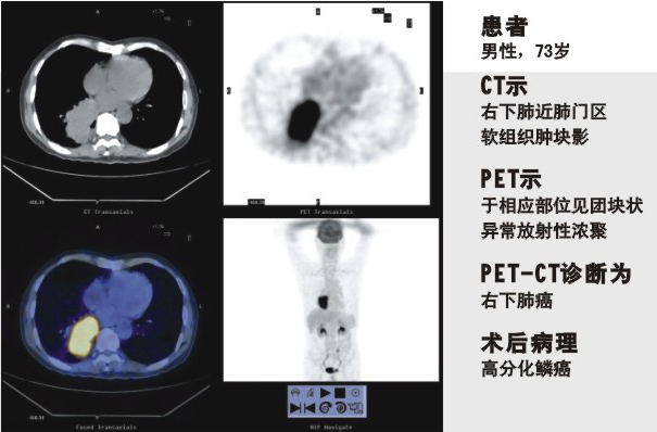PET-CT的獨特功能