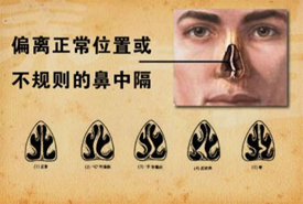 鼻中隔偏曲科普知識